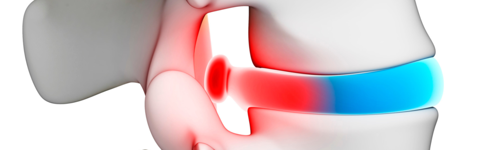 The Role of Inflammation in Spinal Health and How Chiropractic Can Help