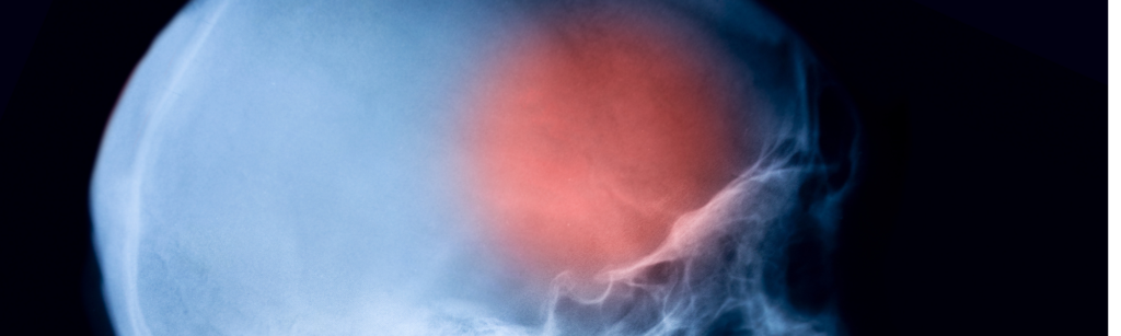 Chiropractic Care for Migraines: How it Can Help